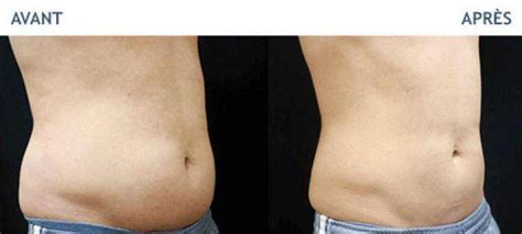 coolsculpting saudi arabia|CoolSculpting.